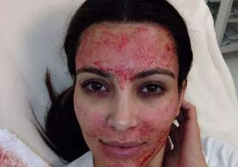 Nasib Malang! Lakukan Perawatan Vampire Facial, Wanita Ini Malah Kena HIV