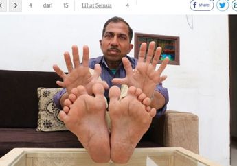 Punya 28 Jari dan Dikenal Banyak Orang, Kehidupan Pria Ini Malah Prihatinkan