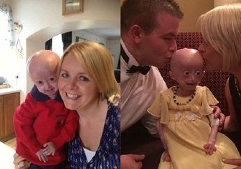 Mengidap Penyakit Langka, Anak ini Menua Lebih Cepat Hingga Akhirnya Meninggal di Usia 8 Tahun