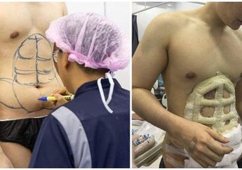 Tren Operasi Six Pack di Thailand, Rahasia Dapatkan Perut Berotot Secara Instan Tanpa Olahraga