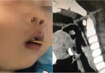 Ngilu! Bocah 3 Tahun ini Tertusuk Lidi Sosis Bakar Hingga Tembus ke Otaknya