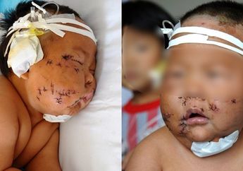 Miris! Bayi 8 Bulan Ditusuk 90 Kali karena Menggigit Puting Ibunya Saat Menyusu