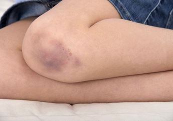 Sering Alami Luka Memar Setelah Bangun Tidur? Hati-hati Bisa Jadi Indikasi Penyakit ini!