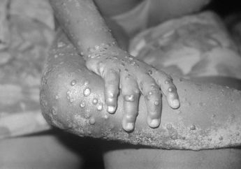 Alami Sistem Kekebalan Tubuh yang Parah, Pasien Cacar Monyet di Amerika Meninggal Dunia, Penyebab Pasti Masih Terus Didalami Oleh Para Ahli