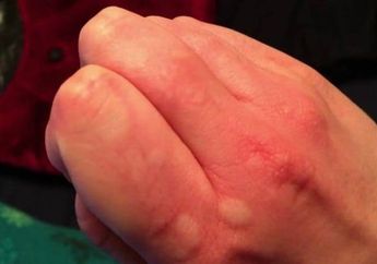 Obati Biduran dengan Antihistamin Alami yang Mudah Didapatkan, Ini Dia