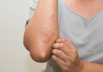 Inilah Penyebab Biduran, Ternyata Gangguan Gigi Bisa Menjadi Salah Satunya