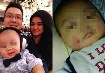 Bayinya Alami Kelainan Kulit Kronis Usai Dibawa Kondangan, sang Ayah Mengaku Menyesal: Jangan Pegang-pegang Anak Gua!