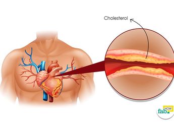 Kolesterol Jadi Pemicu Timbulnya Penyakit Berbahaya, Kenali Cara Penanganannya
