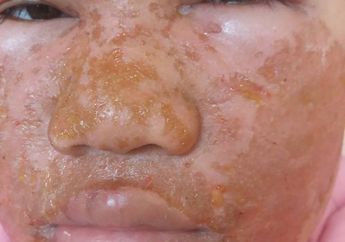 Akibat Pakai Skincare Palsu, Kulit Wajah Wanita Ini Malah Melepuh