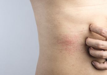 Nyeri Berlebihan pada Kulit, Tandanya Kamu Alami Keracunan Matahari