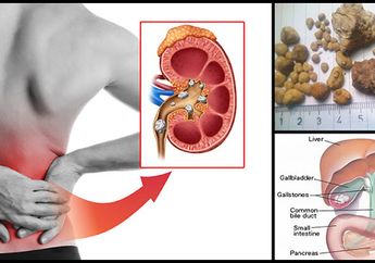 56 Batu Ginjal Berhasil Dikeluarkan Oleh Dokter dari Anak Berusia 9 Tahun, Sering Makan Daging Jadi Salah Satu Penyebabnya!