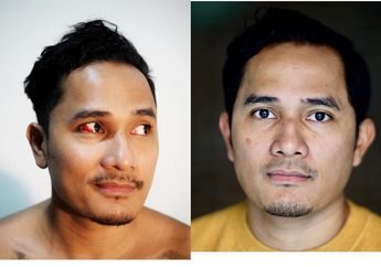 Stress dan Kebanyakan Main Handphone, Pembuluh Darah Mata Tanta Ginting Pecah!