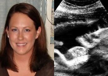 Wanita ini Mengklaim Telah Melahirkan 'Bayi Setan' yang Hidup Dalam Kondisi Janin Tak Lazim