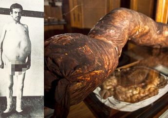 Alami Sembelit Seumur Hidup, Usus Pria ini Berkahir Dipajang di Museum