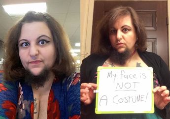 Kisah Little Bear, Wanita Berjenggot Hingga Jarang Menstruasi yang Menemukan Cinta Sejatinya