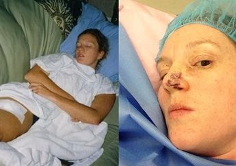 Ingin Kulitnya Terlihat Lebih Gelap, Wanita ini Justru Berakhir dengan Operasi Kanker Kulit 86 Kali