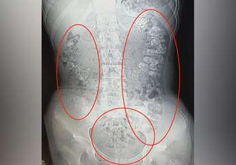 Gadis Ini Mengeluh Sakit Perut Setelah Minum Bubble Tea, Tak Disangka Ini yang Ditemukan Dokter!