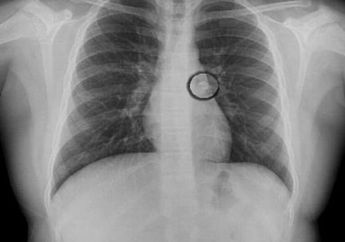 Gigi Gadis Ini Tersangkut di Saluran Pernapasan, Begini Kondisinya Sekarang