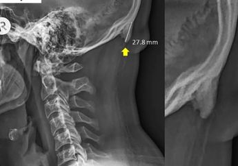 Gadget Ubah Kebiasaan Orang Jadi Sering Menunduk, Peneliti Temukan Fenomena Mengejutkan pada Tengkorak Manusia Generasi Muda!