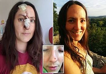 Wanita Ini Kecanduan Berjemur dan Dinyatakan Kanker Kulit   