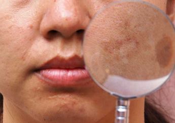 Begini 5 Cara Menghilangkan Melasma di Wajah, Dijamin Ampuh dan Aman!