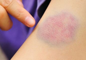 Memar Jadi Salah Satu Gejala Kanker Darah, Kenali 4 Gejala Lainnya yang Sering Diabaikan