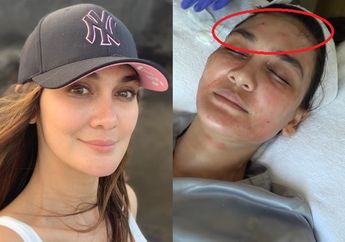 Rela Dilakukan Luna Maya hingga Wajahnya Jadi Bentol-bentol, Ternyata Ada Kisah Soal Bahaya di Balik Vampire Treatment yang Harus Diwaspadai