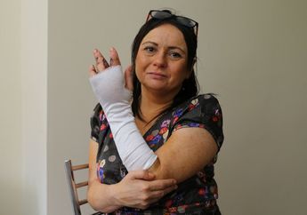 Terkena Cakaran Kucing, Wanita ini Kehilangan Jarinya dan Nyaris Mati!