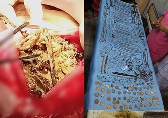 Sering Kehilangan Barang Berharga, Ternyata Koin dan Perhiasan Senilan Rp 924 Juta Ditemukan dalam Perut Anaknya