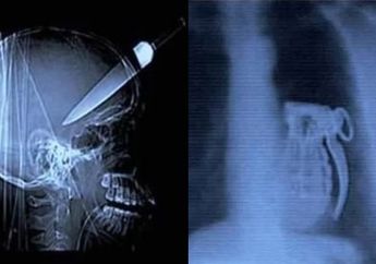 Pisau Hingga Granat, 6 Benda Tak Lazim yang Masuk ke Dalam Tubuh