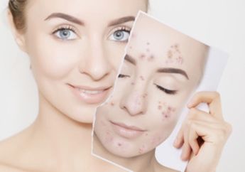 Tutorial Menyamarkan Bekas Jarawat Pakai Makeup Simpel, yuk Kepoin!