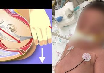 Lakukan Persalinan Forsep, Kepala Bayi Malang ini Terputus, Siapa yang Harus Disalahkan?
