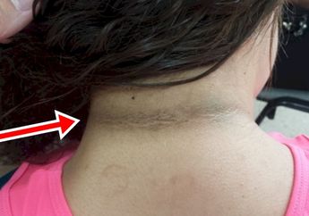 Jangan Salah, Kulit Leher Belakang yang Tebal dan Menghitam Jadi Pertanda Penyakit ini