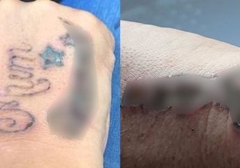 Ingin Hilangkan Tato, Kulit 4 Pria ini Justru Melepuh dan Berlubang