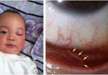 Tak Cuci Tangan dengan Benar, Dokter Keluarkan 10 Cacing dari Mata Balita 2 Tahun ini