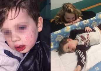 Dicium Kerabatnya, Balita Ini Nyaris Buta Lantaran Tertular Herpes