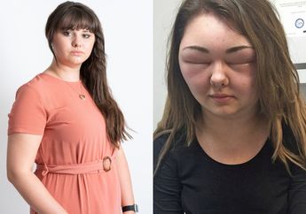 Ingin Tampil Cantik di Ulang Tahun Sang Adik, Kepala Wanita Ini Justru Bengkak Hingga 3 Kali Lipat Usai Warnai Rambutnya