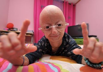 Kisah Claudia  Amaral, Alami Penyakit Langka yang Membuatnya Menua 7 Kali Lipat Lebih Cepat