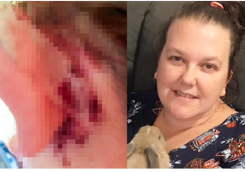 Gara-gara Pakai Cotton Bud, Perempuan Ini Dinyatakan Tuli!