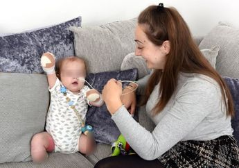 Pilu, Berawal dari Infeksi Tenggorokan Bayi ini Harus Kehilangan Kaki dan Tangannya