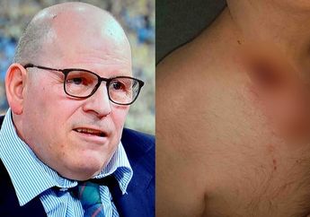 Kebiasaan Mengigit Kuku, Pria 57 Tahun Terkena Sepsis Hingga Buat Tubuhnya Melepuh