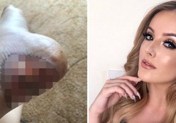 Berawal dari Luka Lecet Karena Sepatunya, Model Cantik ini Nyaris Meninggal Akibat Sepsis