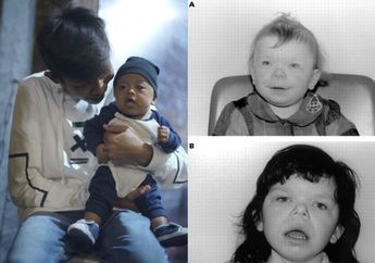 Anak Dede Sunandar Didiagnosis Williams Syndrome, Kenali Lebih Jauh Penyakit Langka Itu!