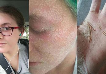 18 Tahun Menggunakan Krim Dokter, Kondisi Kulit Wanita Ini Malah Jadi Mengerikan
