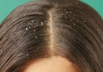 Ajaib! Cuma Pakai Bahan Rumahan yang Dicapur dengan Pasta Gigi, Ketombe di Kulit Kepala Hilang Seketika