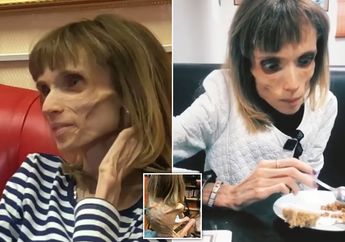 Tinggal Kulit dan Tulang, Wanita Penderita Anoreksia ini Hanya Makan Sepotong Apel dan Air