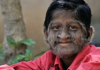 Minum Obat yang Telah Terkontaminasi, 6 Bocah di Spanyol Mendadak Terjangkit Sindrom Manusia Serigala