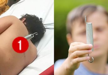 Melompat Terlalu Tinggi, Punggung Bocah 12 Tahun Ini Tertusuk Pegas Trampolin Saat Mendarat