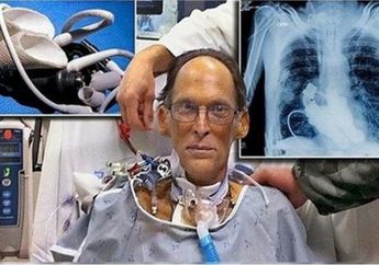 Mengidap Penyakit Langka, Pria Ini Menjadi Manusia Pertama yang Hidup Tanpa Jantung