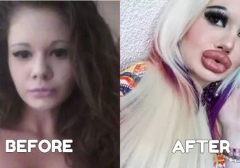 Jalani Filler Bibir 15 Kali Hingga Membesar 3 Kali Lipat, Wanita Ini Justru Mengaku Lebih Pede dengan Ukurannya yang Sekarang